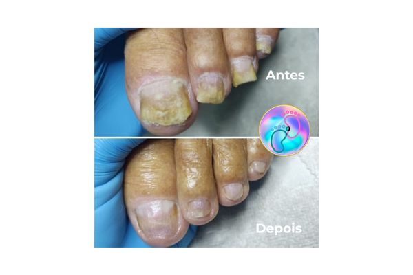 Foto de antes e depois do tratamento 35